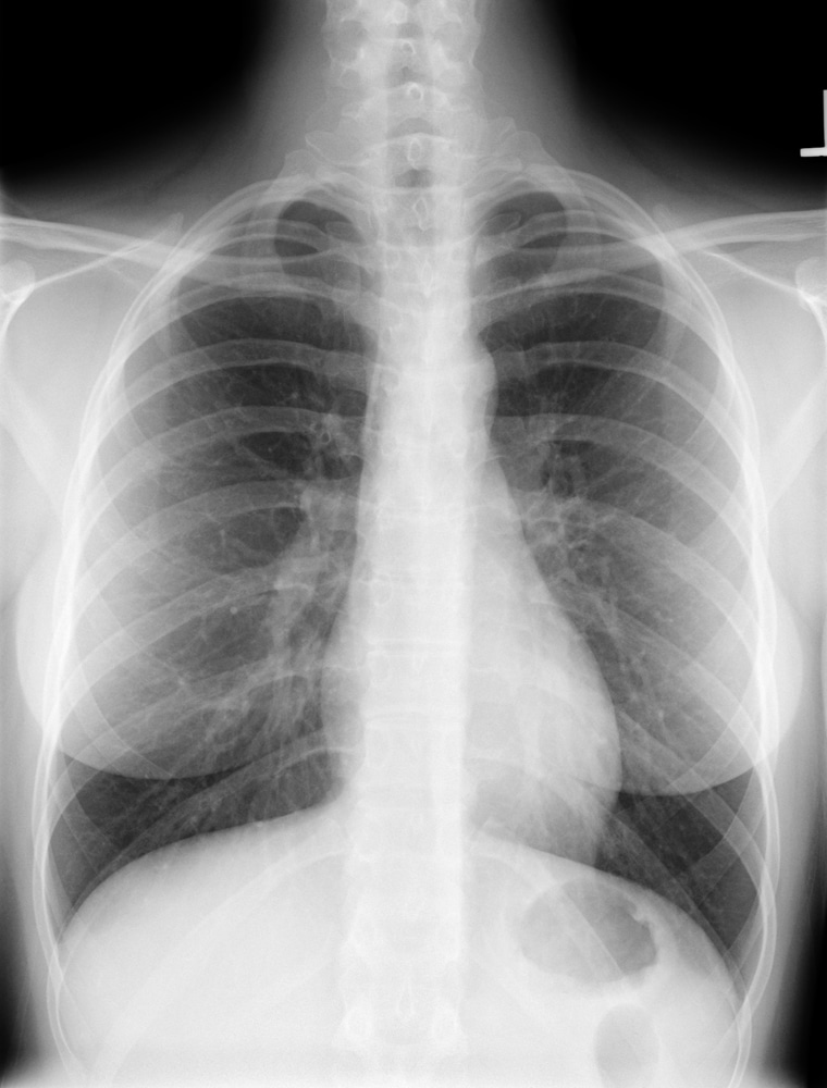 X Ray Of Normal Chest Female Eccles Health Sciences Library J
