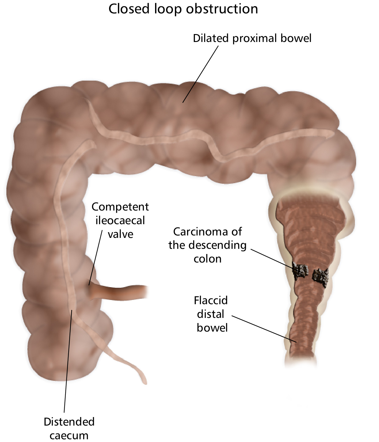 Closed Loop Obstruction of Colon Labeled Eccles Health