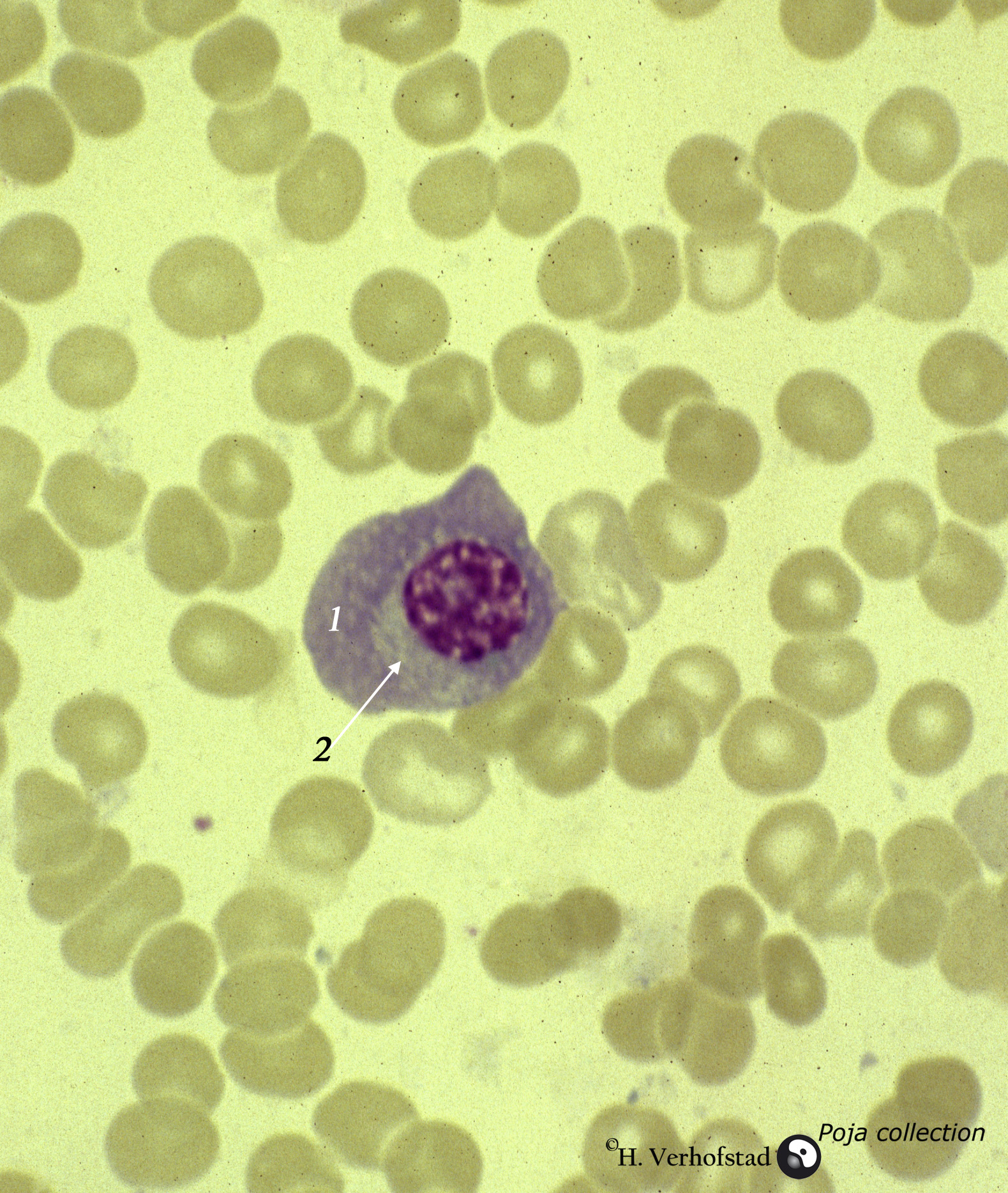 Normal Plasma Cell In Peripheral Blood Smear Human Eccles Health