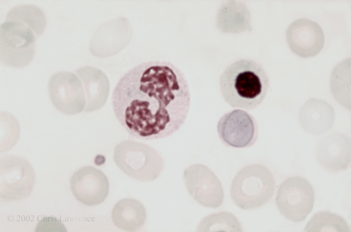Rohan Immunoassay & Pathology Laboratory. - #RBC Inclusions. •Cabot ring..  (In this image of a blood smear from a patient with vitamin B12 deficiency,  the Cabot ring is visible as a inclusion