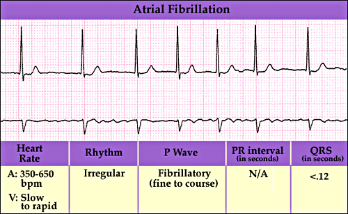 Atrial Fibrillation With Moderate Ventricular Response Marquette