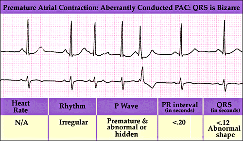PAC With RBBB Aberrant Conduction Eccles Health Sciences Library J 
