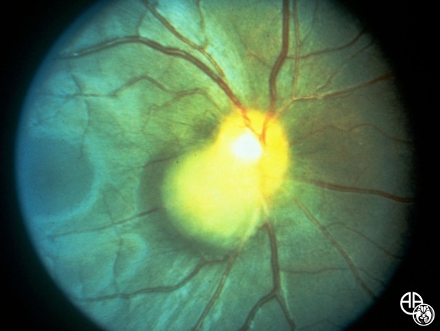 Ocular Manifestations Of Congenital Inherited Diseases Eccles Health