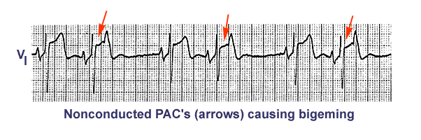 Nonconducted PAC s An Unusual Bigeminy Eccles Health Sciences 