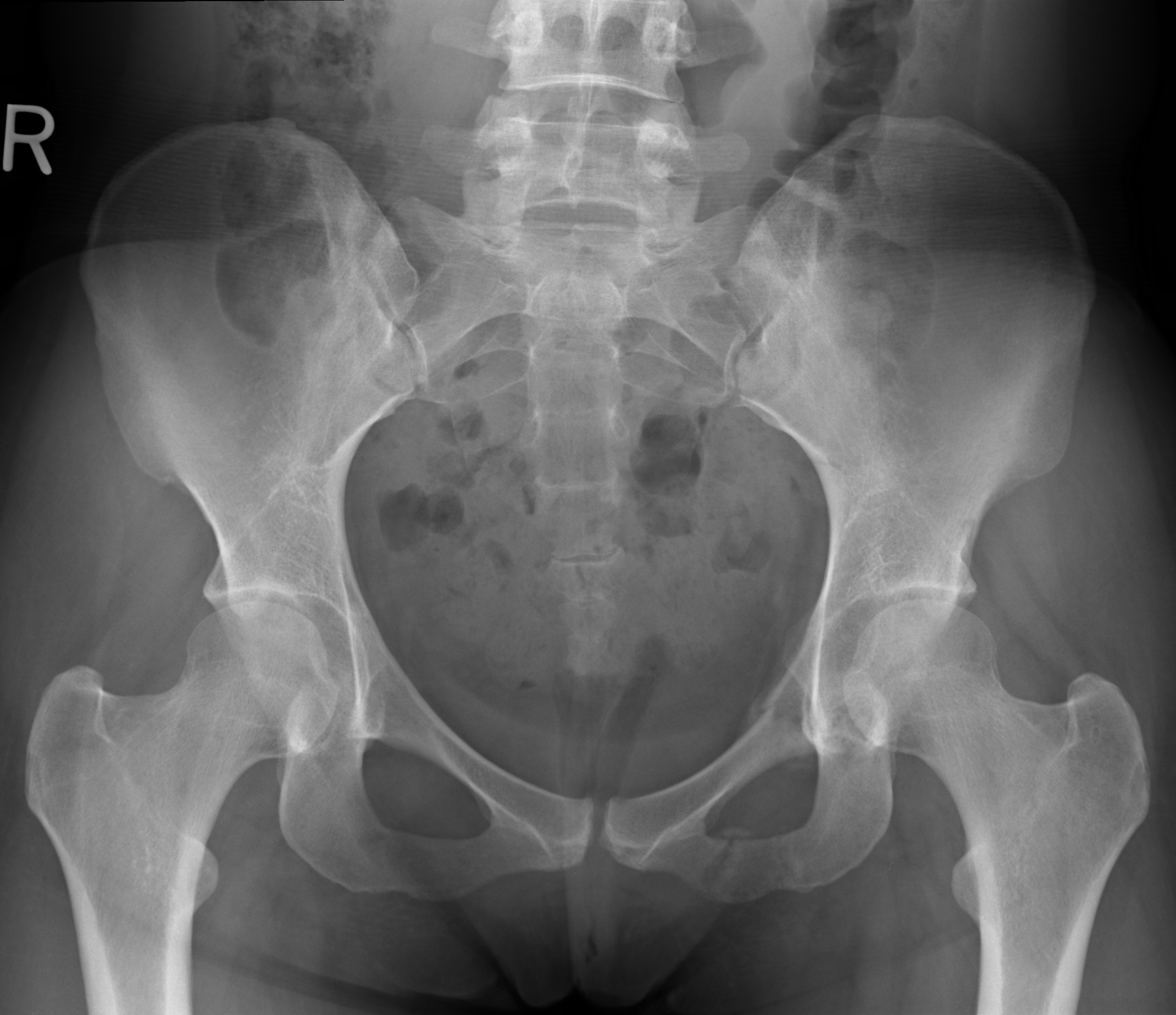 normal hip xray teen