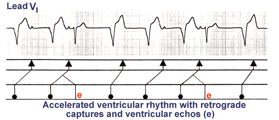 Accelerated ventricular rhythm with retrograde atrial capture and echo beats  | Eccles Health Sciences Library | J. Willard Marriott Digital Library