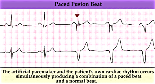Pacemaker fusion beat - marquette | Eccles Health Sciences Library | J.  Willard Marriott Digital Library