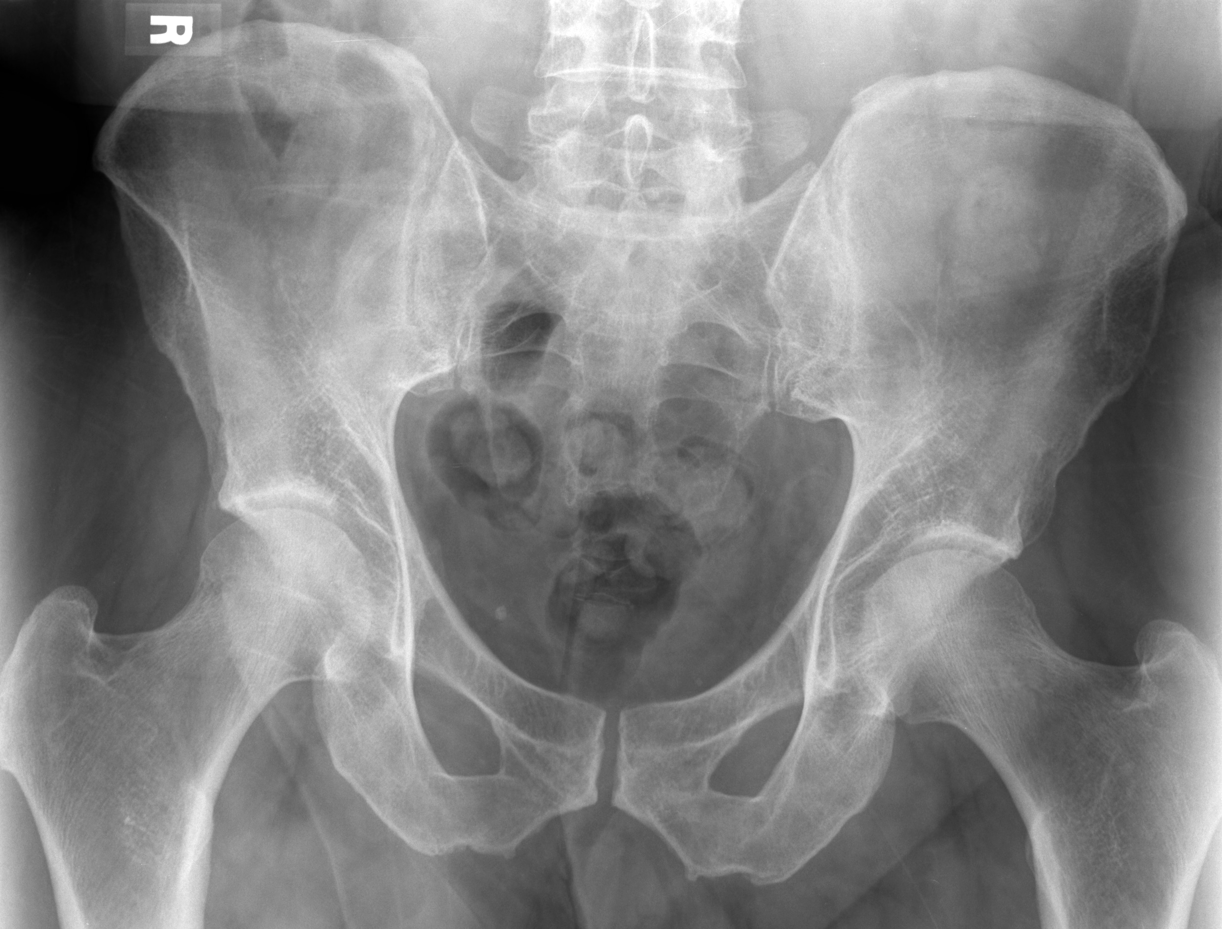 male vs female pelvis x ray